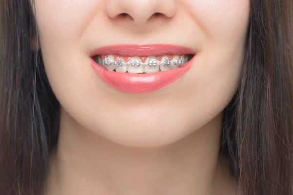 How Self Ligating Braces Make Orthodontics More Comfortable