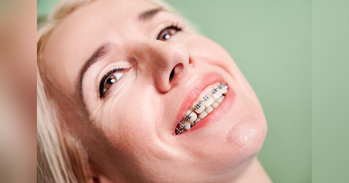 Close-up of a smiling woman with braces on her teeth